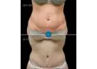 Liposuction Cherry Creek Surgeon